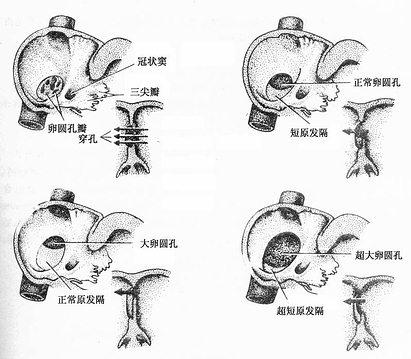 房间隔缺损（右面观）