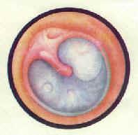 鼓膜粘连及疤痕形成