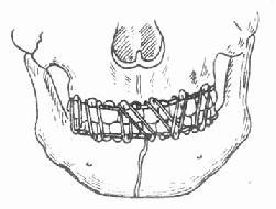 颌间牵引固定法