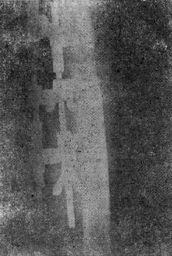 第71章　开放性骨折的治疗