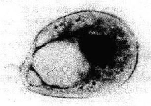 退变的脱落细胞