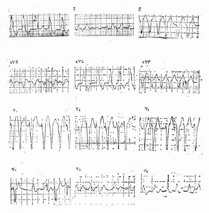 预激综合征合并心房颤动