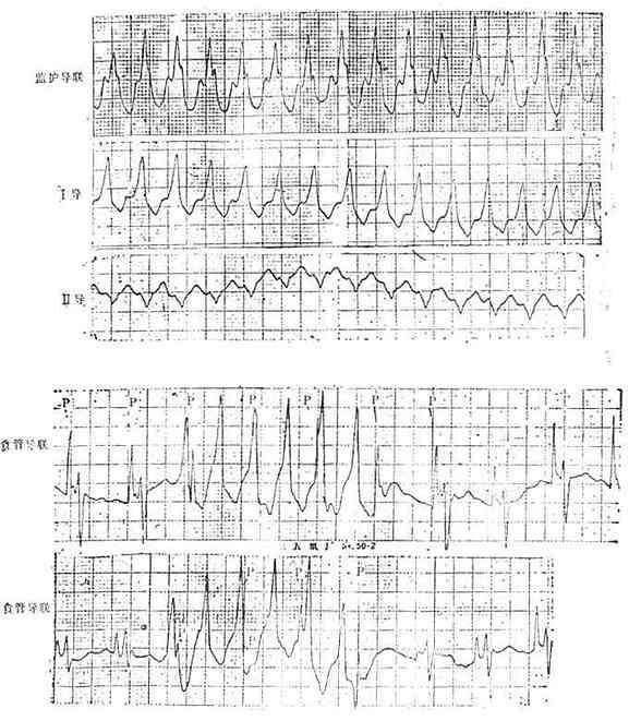 食管导联心电图室速。显示心房电活动波群（P）