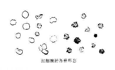 尿内常见的各种细胞