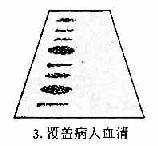 免疫印迹法检查患者血清中的HIV病毒抗体