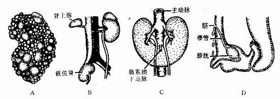 泌尿系统先天性畸形 