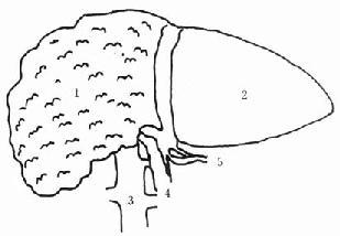 原位辅助性肝移植