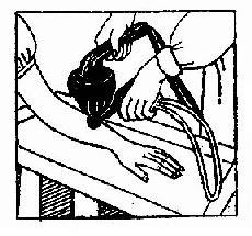 应用水漏凌斗进行超声治疗