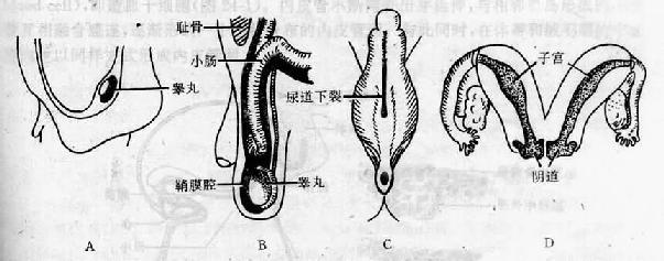 生殖系统先天性畸形 