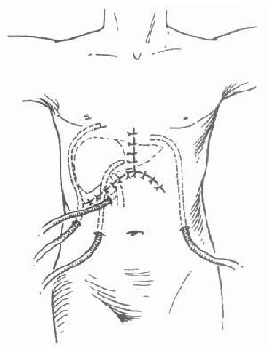 腹腔引流管的放置