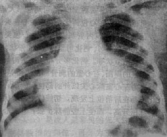 心包积液(后前位)