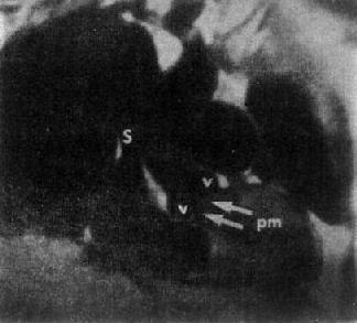 正常心、大血管MRI(SE序列)