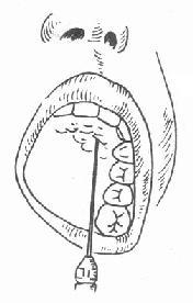 节牙孔注射