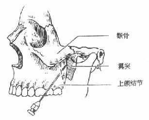 上颌结节注射