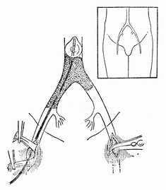 腹主动脉骑跨栓塞自右股总动脉取栓