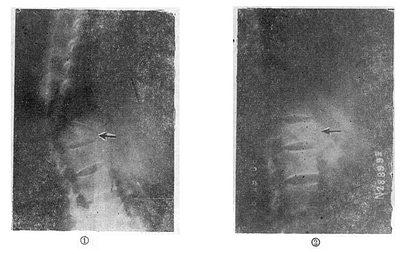 垫枕背伸锻炼获良好结果