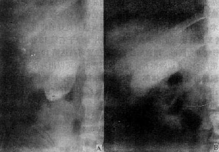 胆襄结石(胆襄造影)