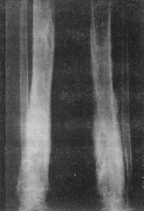 胫骨慢性化脓性骨髓炎,花边状骨膜增生