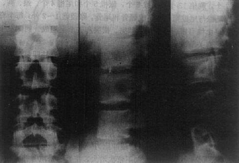 正常腰椎(正位、侧位、斜位)