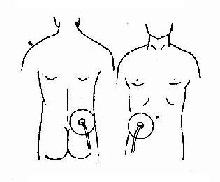 阑尾炎的治疗方法