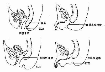 不通肛 