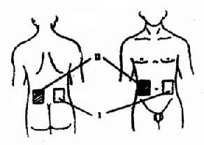 驰发性便秘的固定治疗