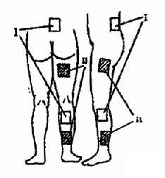 坐骨神经痛治疗