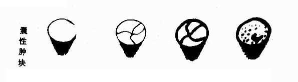 盆腔肿块声象示意图