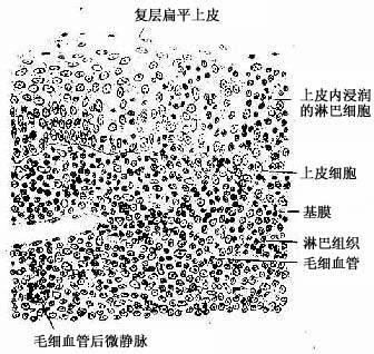 腭扁桃体上皮浸润部 