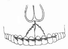 牙槽突骨折和牙弓夹板结扎固定