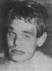 脆性X染色体(Fra X)综合征 患者大耳`大颌