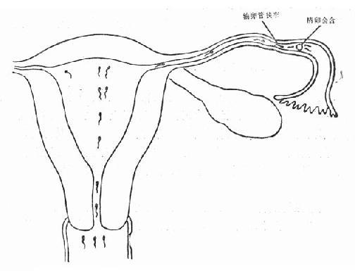 输卵管狭窄形成卵管妊娠