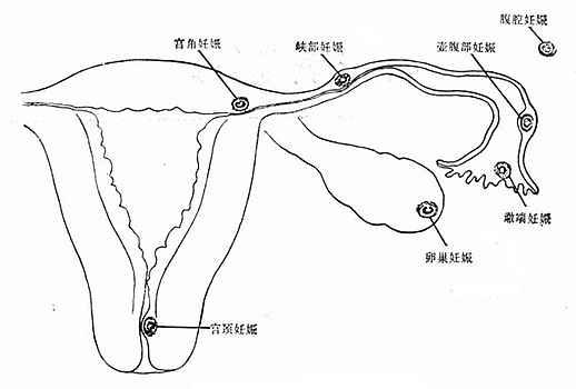 宫外妊娠的部位