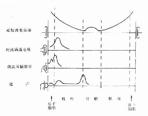 四种深部透热治疗时各层组织温热曲线