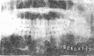 X片示：造釉细胞瘤（下颌体部）